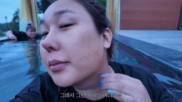 Why did Pungja have facial bruises after losing 12 kg? “Trying to get rid of a double chin...”